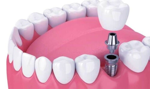 When to Consider Dental Implants Exploring Options for Tooth Replacement