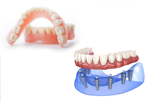 Dental Implants or Dentures Which is Right for You