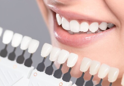 When Is Teeth Whitening Appropriate Considering Factors for a Brighter Smile