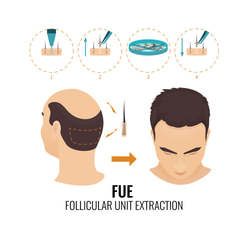 Capital Hair Restoration in Harley Street, London prioritizes quality and precision in their hair transplant procedures by utilizing the latest techniques in the field, such as FUT (Follicular Unit Transplantation) and FUE (Follicular Unit Extraction). These advanced methods allow for minimally invasive surgery, which not only results in natural-looking hair regrowth but also minimizes recovery time for patients. Located in the prestigious Harley Street medical area, the clinic boasts a team of highly skilled professionals dedicated to providing personalized care tailored to each patient's needs. Their approach combines surgical and non-surgical solutions to address hair loss in men and women, ensuring optimal outcomes for all their patients.