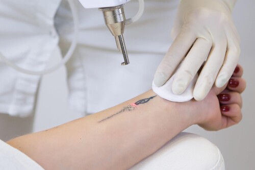 This blog is a guide for everyone who wants to go for a laser tattoo removal procedure. Here are some aftercare tips for getting your tattoos removed.
Read this post at https://tinyurl.com/2xbzw29w