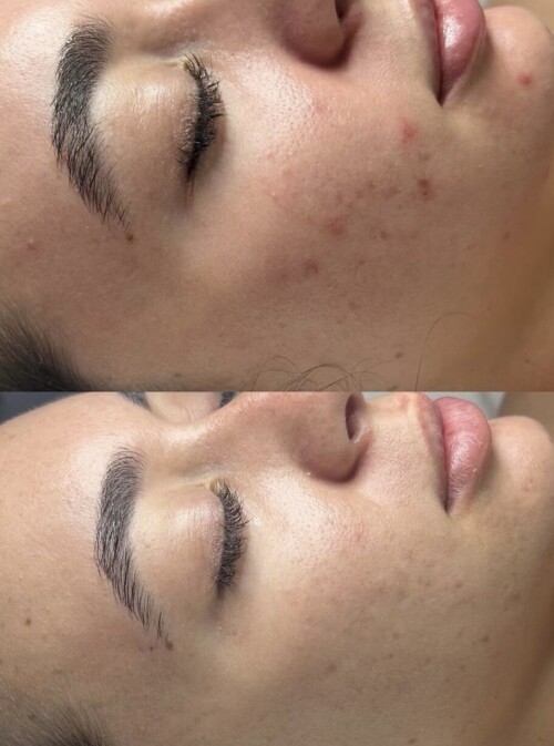 If you want your skin to be in good condition with the use of chemicals, let our safe and reliable mandelic acid peel in Sydney help you! Visit us: https://adamandevelaser.com.au/product/mandelic-acid-peel/