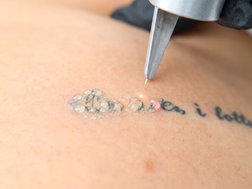 Discover why laser treatment is considered the best tattoo removal method for safe, effective fading with minimal scarring and downtime.

Visit us : https://tinyurl.com/nh8w385d